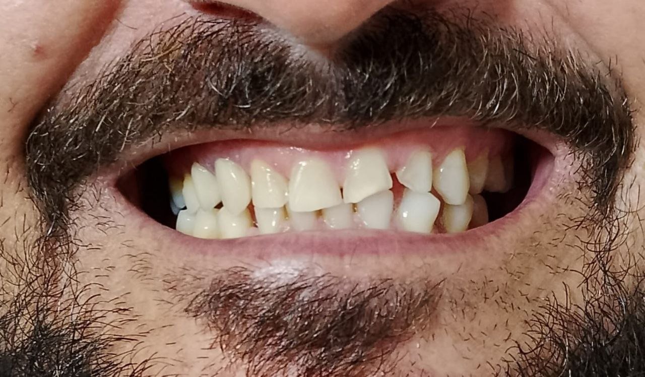 Antes das facetas em resina