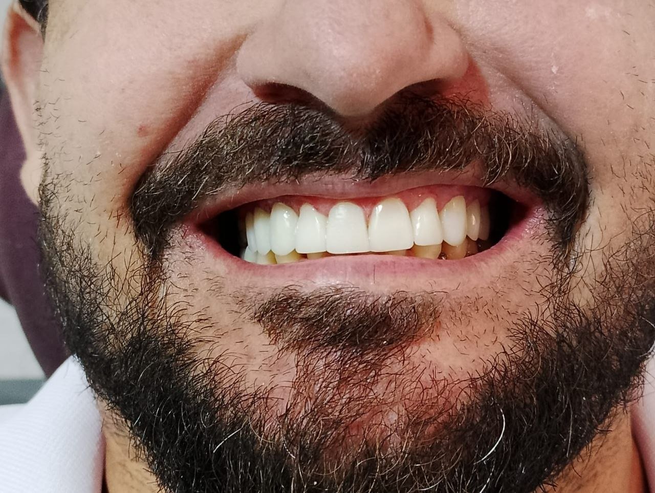 Depois das facetas em resina