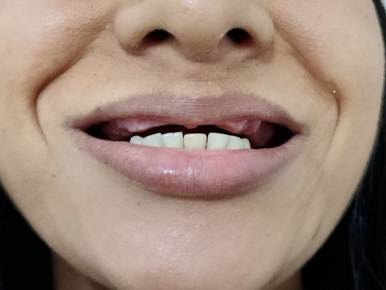 Antes da prótese total com dentes clareados