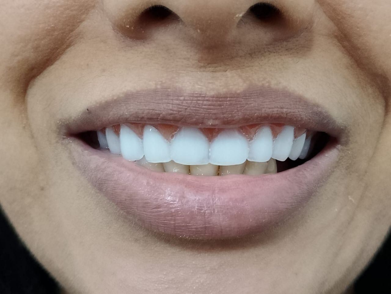 Depois da prótese total com dentes clareados